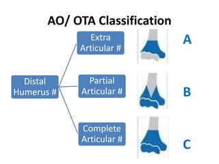 AO/ OTA Classification
Distal
Humerus #
Extra
Articular #
Partial
Articular #
Complete
Articular #
A
B
C
 