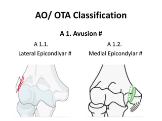 AO/ OTA Classification
A 1. Avusion #
A 1.1. A 1.2.
Lateral Epicondlyar # Medial Epicondylar #
 