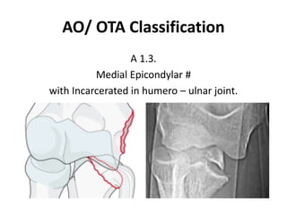 AO/ OTA Classification
A 1.3.
Medial Epicondylar #
with Incarcerated in humero – ulnar joint.
 
