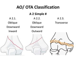 AO/ OTA Classification
A 2 Simple #
A 2.1. A 2.2. A 2.3.
Oblique Oblique Transverse
Downward Downward
Inward Outward
 