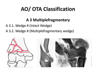 AO/ OTA Classification
A 3 Multiplefragmentary
A 3.1. Wedge # (Intact Wedge)
A 3.2. Wedge # (Multiplefragmentary wedge)
 