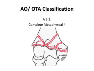 AO/ OTA Classification
A 3.3.
Complete Metaphyseal #
 