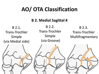 AO/ OTA Classification
B 2. Medial Sagittal #
B 2.1.
Trans-Trochler
Simple
(via Medial side)
B 2.2.
Trans-Trochler
Simple
(via Groove)
B 2.3.
Trans-Trochler
Multifragmentary
 