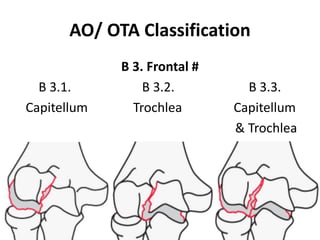 AO/ OTA Classification
B 3. Frontal #
B 3.1. B 3.2. B 3.3.
Capitellum Trochlea Capitellum
& Trochlea
 