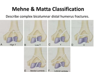 Mehne & Matta Classification
Describe complex bicolumnar distal humerus fractures.
 
