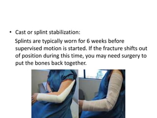 • Cast or splint stabilization:
Splints are typically worn for 6 weeks before
supervised motion is started. If the fracture shifts out
of position during this time, you may need surgery to
put the bones back together.
 