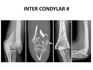 INTER CONDYLAR #
 