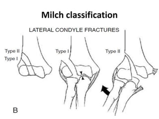 Milch classification
 