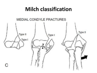 Milch classification
 