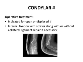 CONDYLAR #
Operative treatment:
• Indicated for open or displaced #
• Internal fixation with screws along with or without
collateral ligament repair if necessary.
 