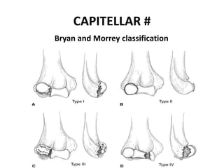 CAPITELLAR #
Bryan and Morrey classification
 