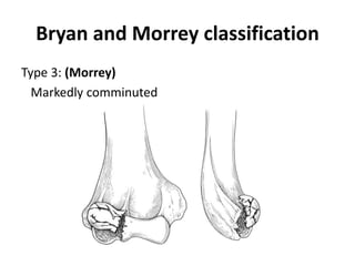 Bryan and Morrey classification
Type 3: (Morrey)
Markedly comminuted
 