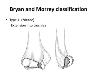Bryan and Morrey classification
• Type 4: (McKee)
Extension into trochlea
 