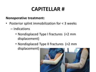 CAPITELLAR #
Nonoperative treatment:
• Posterior splint immobilization for < 3 weeks
– indications
• Nondisplaced Type I fractures (<2 mm
displacement)
• Nondisplaced Type II fractures (<2 mm
displacement)
 