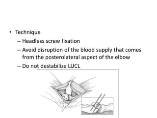 • Technique
– Headless screw fixation
– Avoid disruption of the blood supply that comes
from the posterolateral aspect of the elbow
– Do not destabilize LUCL
 