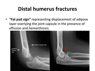 Distal humerus fractures
• “Fat pad sign” representing displacement of adipose
layer overlying the joint capsule in the presence of
effusion and hemarthrosis.
 