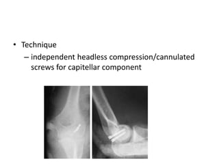• Technique
– independent headless compression/cannulated
screws for capitellar component
 