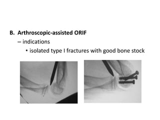 B. Arthroscopic-assisted ORIF
– indications
• isolated type I fractures with good bone stock
 