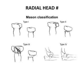 RADIAL HEAD #
Mason classification
 