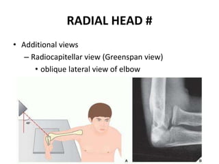 RADIAL HEAD #
• Additional views
– Radiocapitellar view (Greenspan view)
• oblique lateral view of elbow
 