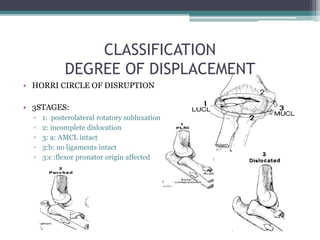 CLASSIFICATION
DEGREE OF DISPLACEMENT
• HORRI CIRCLE OF DISRUPTION
• 3STAGES:
▫ 1: posterolateral rotatory subluxation
▫ 2: incomplete dislocation
▫ 3: a: AMCL intact
▫ 3:b: no ligaments intact
▫ 3:c :flexor pronator origin affected
 