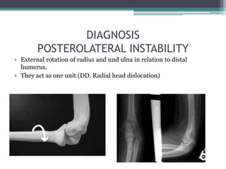 DIAGNOSIS
POSTEROLATERAL INSTABILITY
• External rotation of radius and und ulna in relation to distal
humerus.
• They act as one unit (DD. Radial head dislocation)
 