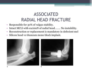 ASSOCIATED
RADIAL HEAD FRACTURE
• Responsible for 30% of valgus stability.
• Intact MCLl with excisioN of radial head…….. No instability.
• Reconstruction or replacement is mandatory in defecient mcl
• Silicon head vs titaneum mono block implant.
 
