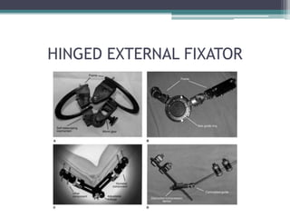 HINGED EXTERNAL FIXATOR
 