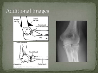 Radial Head Fracture | PPTX