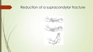 Reduction of a supracondylar fracture
 