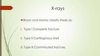 X-rays
Bryan and Morrey classify these as:
i. Type I Complete fracture
ii. Type II Cartilaginous shell
iii. Type III Comminuted fracture.
 