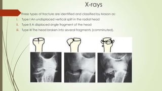 X-rays
 Three types of fracture are identified and classified by Mason as:
i. Type I An undisplaced vertical split in the radial head
ii. Type II A displaced single fragment of the head
iii. Type III The head broken into several fragments (comminuted).
 