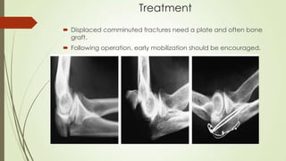 Treatment
 Displaced comminuted fractures need a plate and often bone
graft.
 Following operation, early mobilization should be encouraged.
 