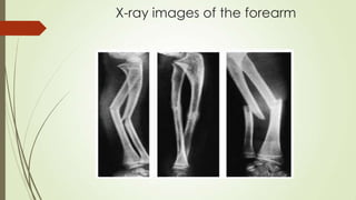 X-ray images of the forearm
 