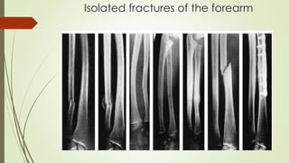 Isolated fractures of the forearm
 