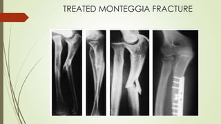 TREATED MONTEGGIA FRACTURE
 
