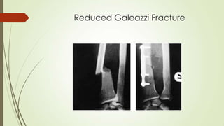 Reduced Galeazzi Fracture
 