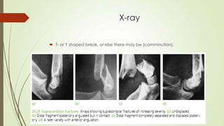 X-ray
 T- or Y shaped break, or else there may be (comminution).
 