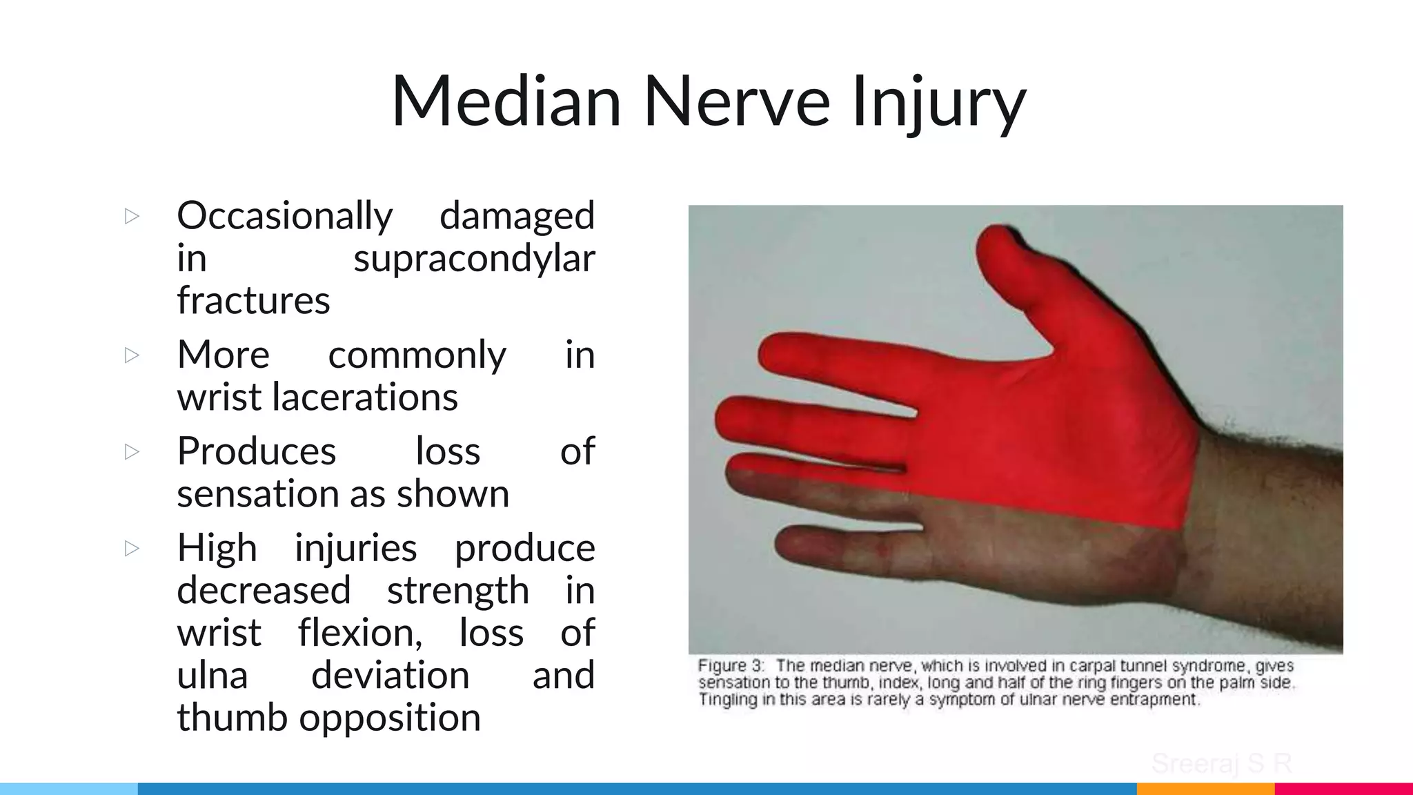 Sreeraj S R
Median Nerve Injury
▷ Occasionally damaged
in supracondylar
fractures
▷ More commonly in
wrist lacerations
▷ Produces loss of
sensation as shown
▷ High injuries produce
decreased strength in
wrist flexion, loss of
ulna deviation and
thumb opposition
 