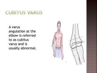 A varus
angulation at the
elbow is referred
to as cubitus
varus and is
usually abnormal.
 