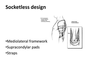 Socketless design
•Mediolateral framework
•Supracondylar pads
•Straps
 