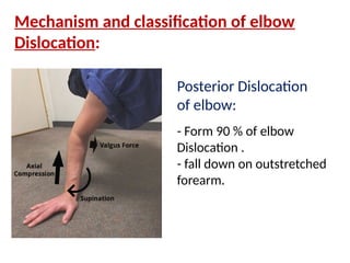 Elbow Dislocation - Anatomy WPS Office.pptx