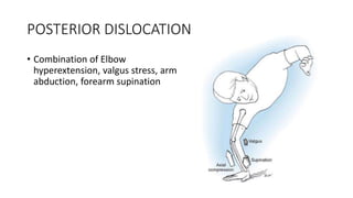 POSTERIOR DISLOCATION
• Combination of Elbow
hyperextension, valgus stress, arm
abduction, forearm supination
 
