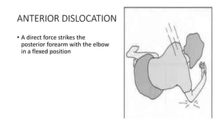 ANTERIOR DISLOCATION
• A direct force strikes the
posterior forearm with the elbow
in a flexed position
 