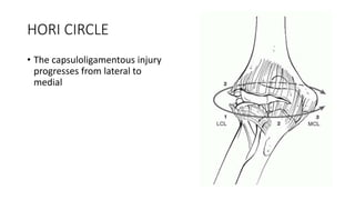 HORI CIRCLE
• The capsuloligamentous injury
progresses from lateral to
medial
 