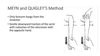 MEYN and QUIGLEY’S Method
• Only forearm hangs from the
stretcher.
• Gentle downward traction of the wrist
with reduction of the olecranon with
the opposite hand.
 