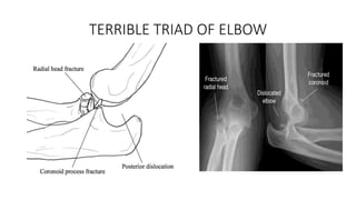 TERRIBLE TRIAD OF ELBOW
 