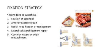 FIXATION STRATEGY
• From deep to superficial
1. Fixation of coronoid
2. Anterior capsule repair
3. Radial head fixation or replacement
4. Lateral collateral ligament repair
5. Common extensor origin
reattachment.
 
