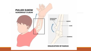 ELBOW DISLOCATION for medical students.pptx