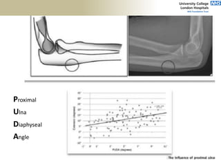 Proximal
Ulna
Diaphyseal
Angle
 